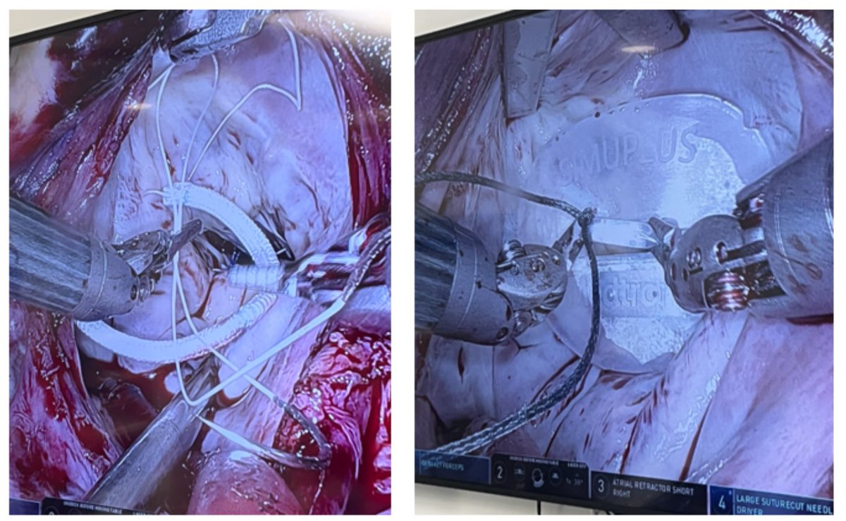 Gianluigi Bisleri, MD (@gbisleri) on Twitter photo Extremely thrilled to achieve this milestone together with <a href="/DJPBurns/">Dr. Daniel Burns</a> —the first minimally invasive robotic mitral repair in the GTA! A major achievement made possible by our incredible MICS program and the amazing support at <a href="/UnityHealthTO/">Unity Health Toronto</a> . Grateful for the teamwork! Extremely thrilled to achieve this milestone together with <a href="/DJPBurns/">Dr. Daniel Burns</a> —the first minimally invasive robotic mitral repair in the GTA! A major achievement made possible by our incredible MICS program and the amazing support at <a href="/UnityHealthTO/">Unity Health Toronto</a> . Grateful for the teamwork!