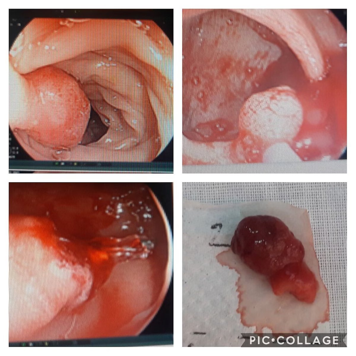 EndoCollabcom's tweet image. Post-Polypectomy Bleeding Tip

If there is bleeding from there stalk, you can apply strangulation pressure with the snare while your assistant gets ready with the hemostatic utensils (e.g. needle, clips).

Tip and Photos: via Dr. S. Carrion, Cuenca, Ecuador