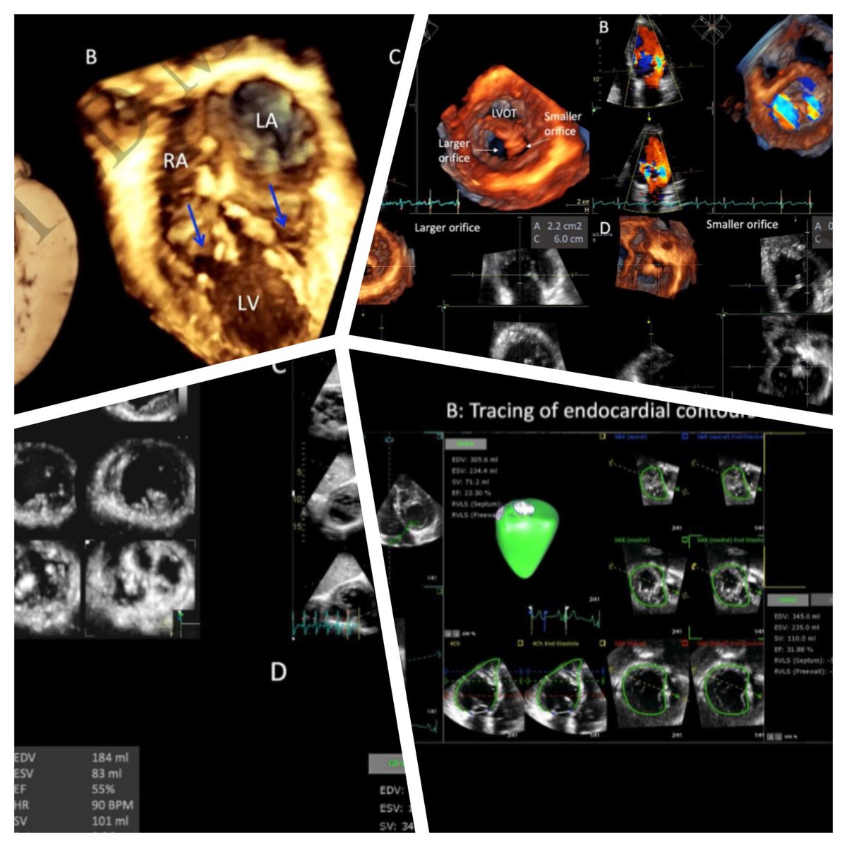 EHJCVI Editor-in-Chief (@ehjcvieic) on Twitter photo 3-dimensional #echofirst in Adults with Congenital Heart Disease. A Scientific Statement of the ESC Working Group on Adult Congenital Heart Disease and the European Association of Cardiovascular Imaging of the ESC by <a href="/ElenaSurkova9/">Elena Surkova</a> and colleagues <a href="/ESC_Journals/">European Society of Cardiology Journals</a> <a href="/bernhard_gerber/">Bernhard Gerber</a> 3-dimensional #echofirst in Adults with Congenital Heart Disease. A Scientific Statement of the ESC Working Group on Adult Congenital Heart Disease and the European Association of Cardiovascular Imaging of the ESC by <a href="/ElenaSurkova9/">Elena Surkova</a> and colleagues <a href="/ESC_Journals/">European Society of Cardiology Journals</a> <a href="/bernhard_gerber/">Bernhard Gerber</a>