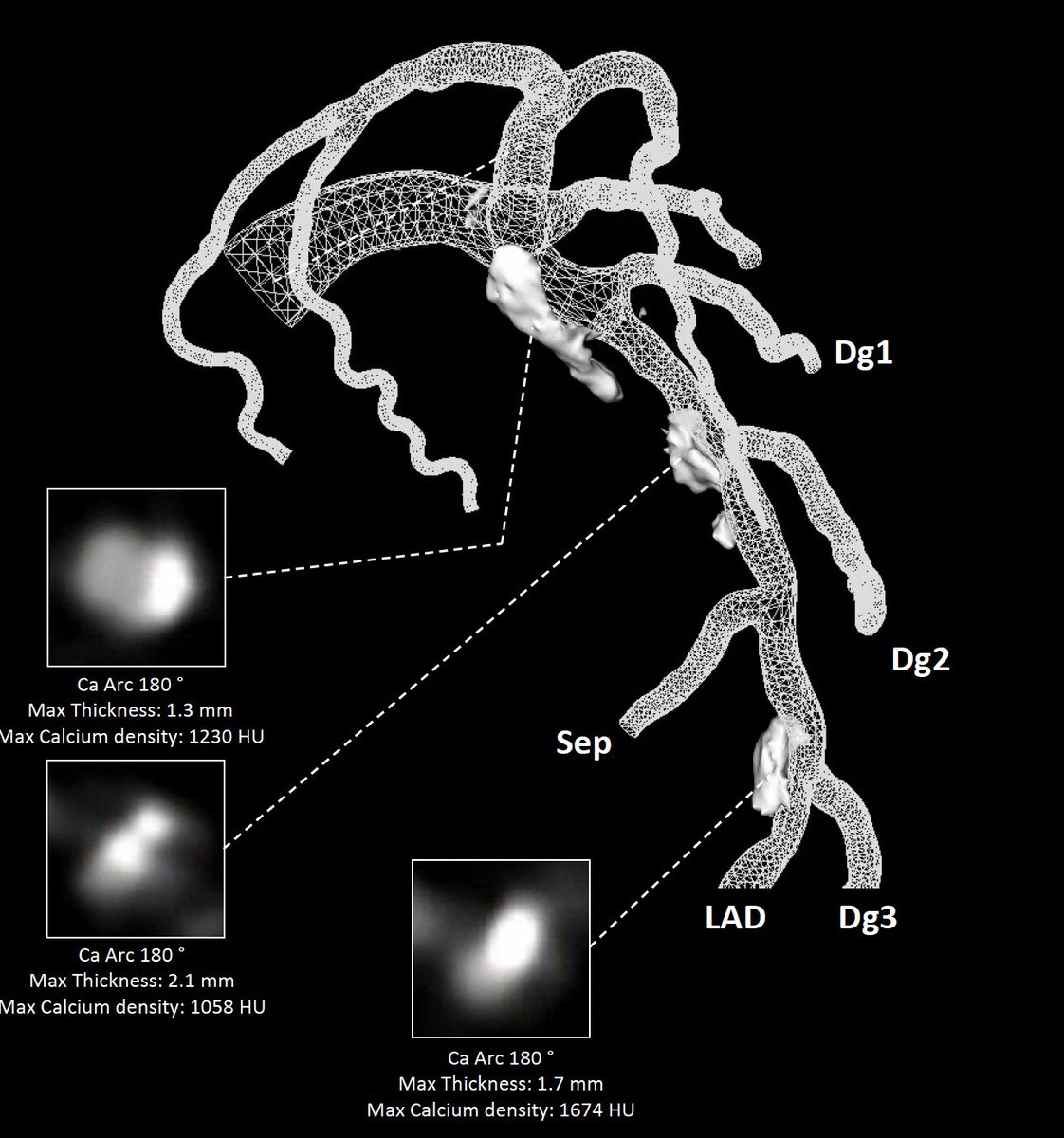 Carlos Collet MD PhD (@colletcarlos) on Twitter photo 🚨Last cases from #P4
Severe calcified plaque 🦴extending from the left main into the LAD #CTguidedPCI
How would you approach calcium modification in this bifurcation?
<a href="/PCRonline/">PCRonline 🫀</a> <a href="/TCTMD/">TCTMD</a> <a href="/ziadalinyc/">Ziad Ali</a> <a href="/jcspratt/">jcspratt</a> <a href="/JEscaned/">Javier Escaned</a> <a href="/yadersandoval/">Yader Sandoval</a> <a href="/Bhcintervention/">Dan Jones</a> <a href="/sbrugaletta/">Salvatore Brugaletta</a> 🚨Last cases from #P4
Severe calcified plaque 🦴extending from the left main into the LAD #CTguidedPCI
How would you approach calcium modification in this bifurcation?
<a href="/PCRonline/">PCRonline 🫀</a> <a href="/TCTMD/">TCTMD</a> <a href="/ziadalinyc/">Ziad Ali</a> <a href="/jcspratt/">jcspratt</a> <a href="/JEscaned/">Javier Escaned</a> <a href="/yadersandoval/">Yader Sandoval</a> <a href="/Bhcintervention/">Dan Jones</a> <a href="/sbrugaletta/">Salvatore Brugaletta</a>