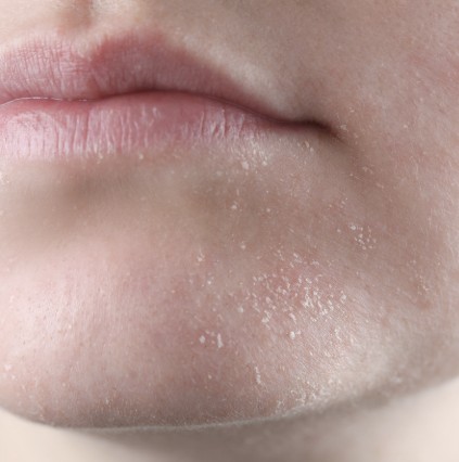 🔰급 두드러지는 각질 + 화장품 밀림  = 각질제거는 일단 스톱!

유수분 밸런스가 깨지기 쉬운 환절기 (온/습도 변화) 에 흔히 나타나는 현상입니다.  
아무튼 이걸 "벗기자 각질!"  로 해결하려고 하면 안됩니다  #삽질
특히 샤워중 불은 각질 손가락 때밀기  #nono 

우선 각질 일어남 사이에