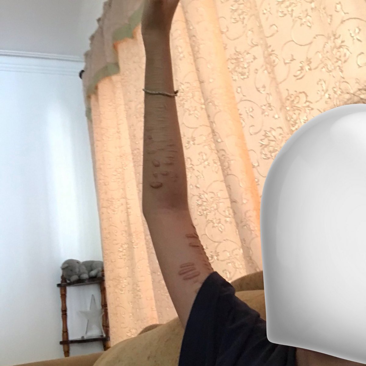 skinnlheart's tweet photo. bmi 20 -> bmi 10 
arm https://t.co/M7wLkFGY5i