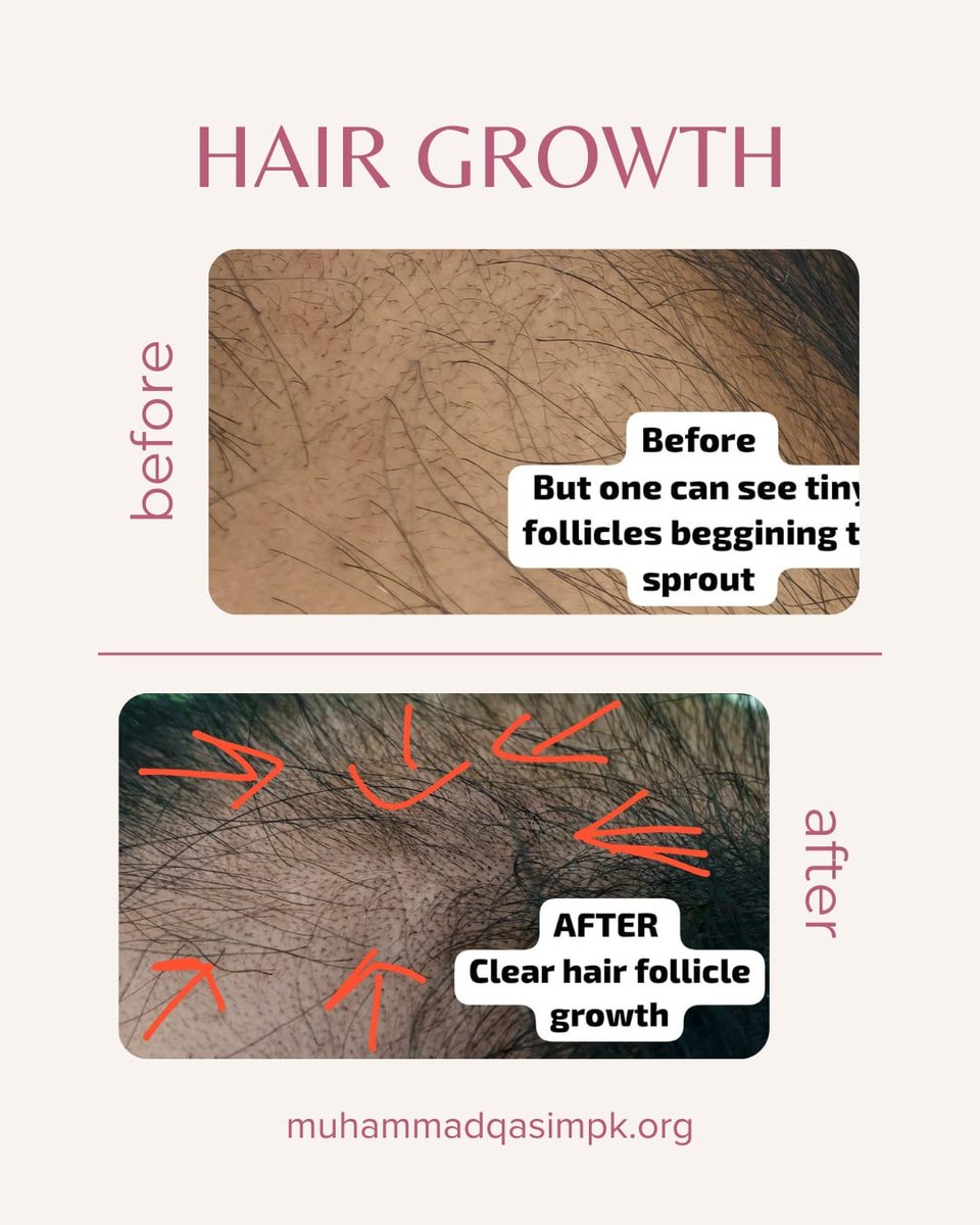 a_muhammad51674's tweet image. 📷 Visible proof.
Muhammad Qasim’s appearance has visibly transformed between Sep 2024 and Mar 2025.
Growth after 40s—unheard of. Yet it&apos;s happening.

#LookAtQasimElon #QasimFeetElongation #MuhammadQasim