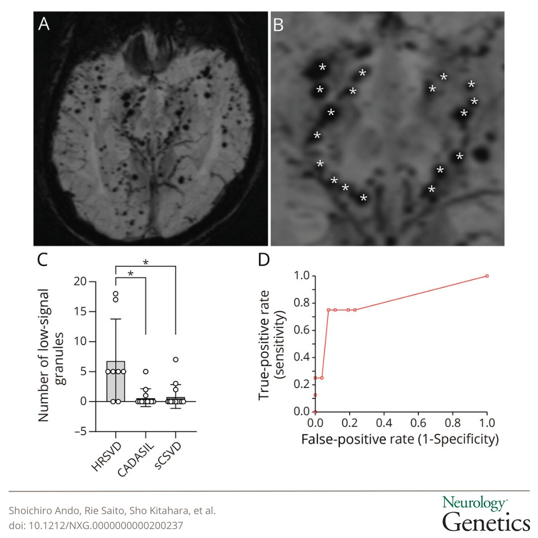 The "Chocolate Chip Sign" on susceptibility-weighted imaging (SWI) represents a novel and promising neuroimaging biomarker for HTRA1-related cerebral small vessel disease. Read this study to learn more: hubs.la/Q03f_g3r0

#NeuroGenetics #NeuroX