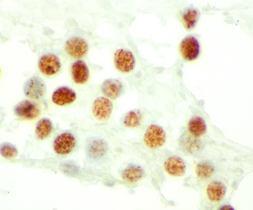 Pepe Jiménez Heffernan (@pepeheffernan) on Twitter photo CC359. Gloomy Sunday case. In his 70s. Pleural effusion. Of course you can. Everything you need is there. Why showing an immuno image? Hahaha!
We have discussed this topic before. Try asking grok
<a href="/kriyer68/">Kalyani Bambal</a> <a href="/DrBMcGinn/">Barry McGinn</a> <a href="/goziemnweke/">idlewild</a> <a href="/DrRanasaleh/">Rana Saleh, MD</a> <a href="/TotalCytopath/">Philippe Stephenson, MD</a> <a href="/AshishC97225686/">Ashish.Chandra</a> CC359. Gloomy Sunday case. In his 70s. Pleural effusion. Of course you can. Everything you need is there. Why showing an immuno image? Hahaha!
We have discussed this topic before. Try asking grok
<a href="/kriyer68/">Kalyani Bambal</a> <a href="/DrBMcGinn/">Barry McGinn</a> <a href="/goziemnweke/">idlewild</a> <a href="/DrRanasaleh/">Rana Saleh, MD</a> <a href="/TotalCytopath/">Philippe Stephenson, MD</a> <a href="/AshishC97225686/">Ashish.Chandra</a>