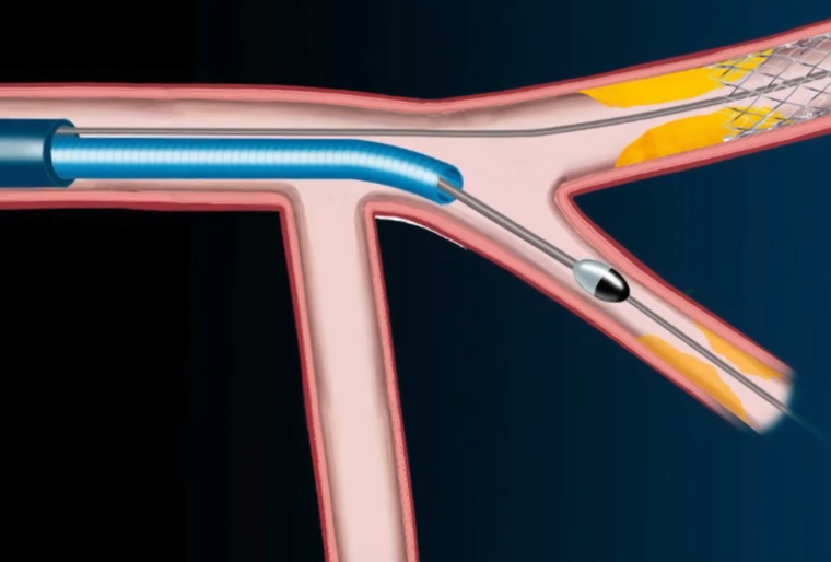 gbiondizoccai's tweet image. Did you know that using an 8 French GC and a GC extension (eg #Guidezilla) you can perform rotablation with a buddy GW? Here's a video which explains how to do it: youtube.com/watch?v=kV3n9u…