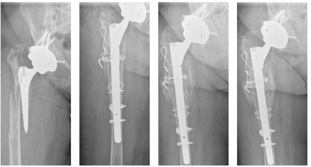 LifetimeHip (@lifetimehip) on Twitter photo 46 #Revision THA B3 with insufficient isthmus
Cone-in-cone + distal interlocking at 4yrs
42 bony + 4 fibrous ingrowth stem
<a href="/BoneJointJ/">The Bone & Joint Journal</a>
#hipreplacement
buff.ly/5BOGCp5 46 #Revision THA B3 with insufficient isthmus
Cone-in-cone + distal interlocking at 4yrs
42 bony + 4 fibrous ingrowth stem
<a href="/BoneJointJ/">The Bone & Joint Journal</a>
#hipreplacement
buff.ly/5BOGCp5