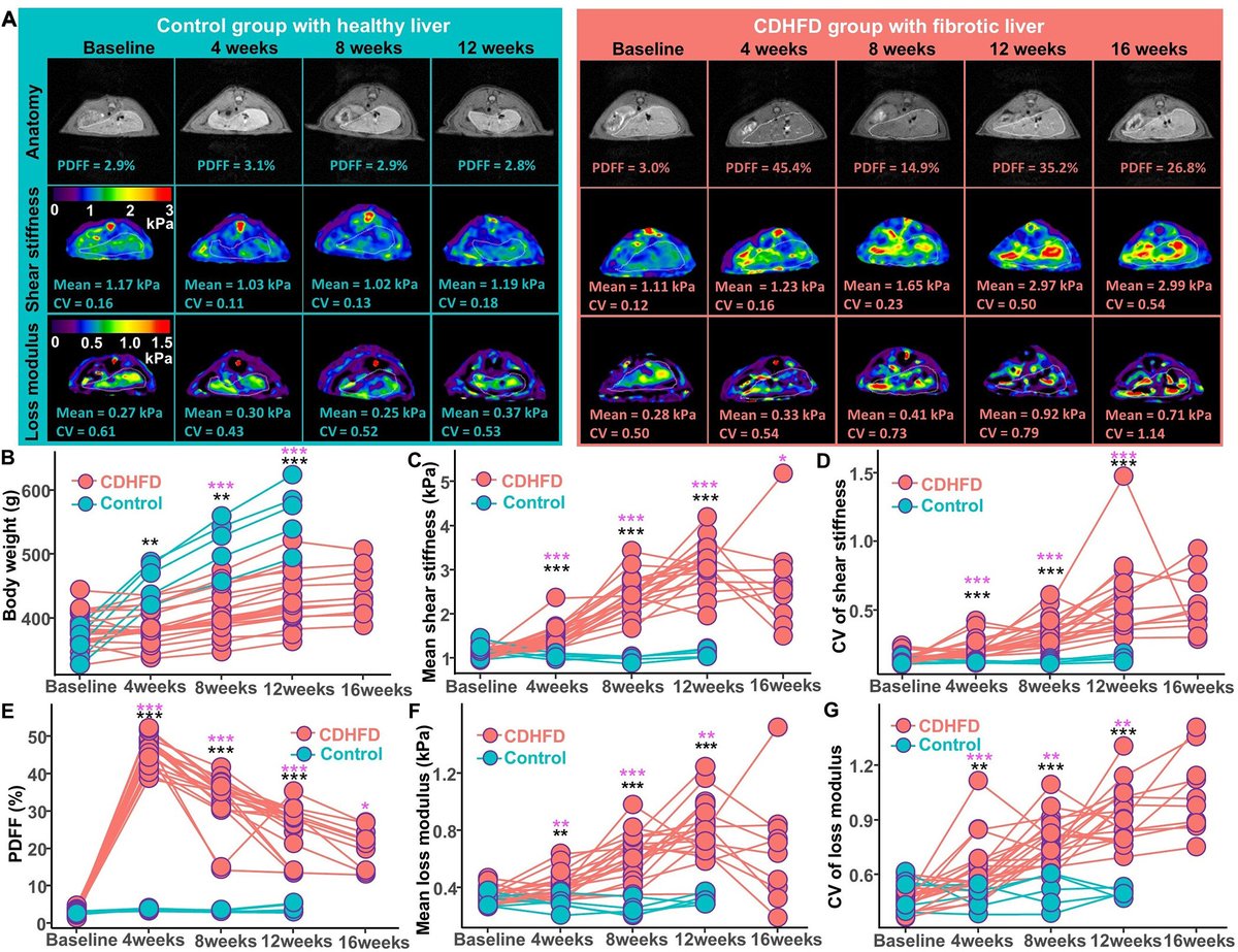 Radiology (@radiology_rsna) on Twitter photo Wu and Zhu et al from <a href="/MayoClinic/">Mayo Clinic</a>/<a href="/MayoRadiology/">Mayo Clinic Radiology</a> studied the association of mechanical liver tissue heterogeneity at MR elastography versus metabolic liver disease progression. Read on to see the results! bit.ly/42qhITG Wu and Zhu et al from <a href="/MayoClinic/">Mayo Clinic</a>/<a href="/MayoRadiology/">Mayo Clinic Radiology</a> studied the association of mechanical liver tissue heterogeneity at MR elastography versus metabolic liver disease progression. Read on to see the results! bit.ly/42qhITG