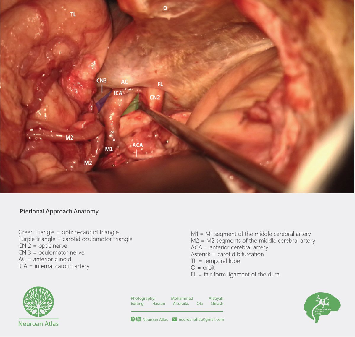 Anatomical View of The Pterional Approach

#NeuroanAtlas #Neuroanatomy #Neurosurgery