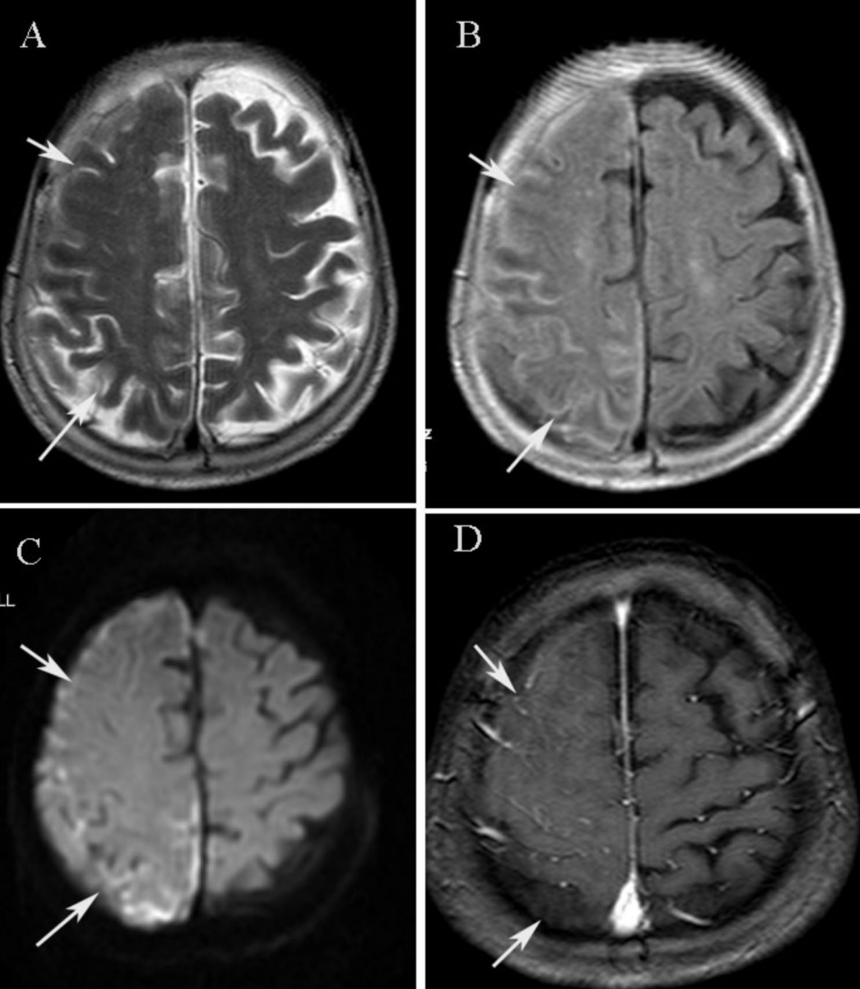 &lt;What’s Your Diagnosis?&gt;

🧍 80F w/ COPD, HTN
🩺 CC: Recurrent brief L limb weakness, no LOC/seizure

🧠 Neuro: Alert, CN−, mild weak (GBS hx), no path reflex
🩸 Labs: CRP 28.5↑, ESR 63↑, CCP &gt;200↑, AKA+
 🧪 CSF: WBC 15, protein 0.78↑, glucose nl, culture−

#Rdiag #NeuroRad