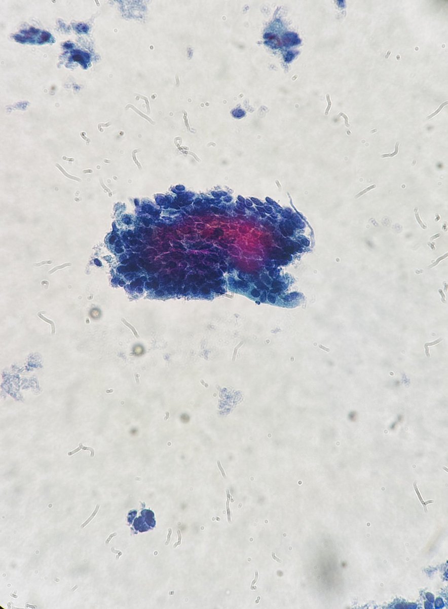 Path4People's tweet image. A difficult case (for me) of atypical glandular cells (AGC)

Not quite AIS with the lack of great feathering. 

One thing my staff taught me is a ddx of AIS is HSIL; on histo sometimes HSIL involves endocervical glands. That can sometimes happen on PAPs too. 

#pathx #cytopath