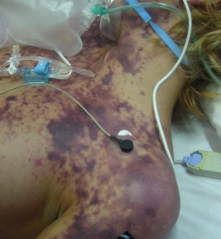 A 22 year old previously well female presents with fevers and sepsis, and a rapidly evolving rash.  She is drowsy, hypotensive and tachycardic

What is the likely diagnosis?

oslercommunity.com/s/preview/quiz…

#meded #medtwitter #tipsfornewdocs #juniordoctors #FOAMed #CPDHomes #CPDHome