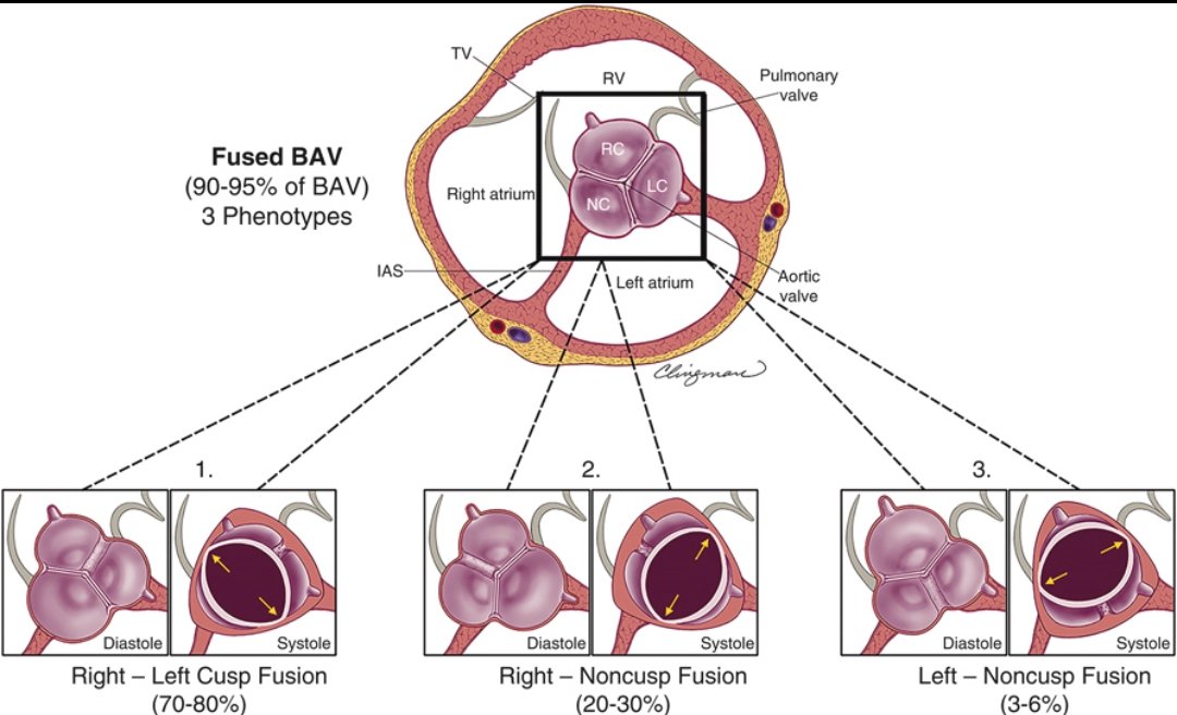 Understanding Bicuspid Aortic Valve (BAV) Morphology – A Key to Better Clinical Decisions

BAV is the most common congenital heart valve anomaly. Around 90–95% of BAVs are of the "fused" type, with three major phenotypes based on cusp fusion:

1. Right–Left Cusp Fusion (70–80%)
-