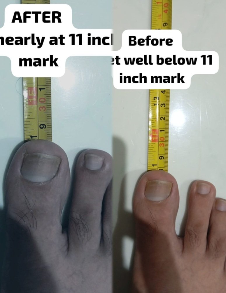 MeraUtami's tweet image. 🔬  49-year-old man is showing new hair growth, feet elongation, and height increase — after adulthood growth should&apos;ve stopped.
Science can&apos;t explain it.

@elonmusk
 should see this.

#LookAtQasimElon #QasimsGrowthSigns #HairGrowthMiracle