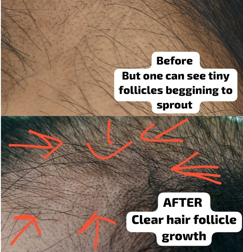 MeraUtami's tweet image. 🔬  49-year-old man is showing new hair growth, feet elongation, and height increase — after adulthood growth should&apos;ve stopped.
Science can&apos;t explain it.

@elonmusk
 should see this.

#LookAtQasimElon #QasimsGrowthSigns #HairGrowthMiracle