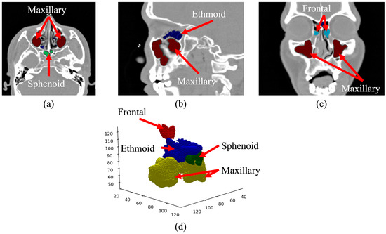 Sensors_MDPI's tweet image. Deep  Learning-Based Multi-Class Segmentation of the Paranasal Sinuses of  Sinusitis Patients Based on Computed Tomographic Images
mdpi.com/1424-8220/24/6…
#ConvolutionalNeuralNetwork #paranasalsinuses