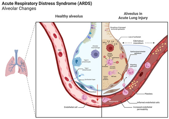 Applied Sciences MDPI (@applsci) on Twitter photo 🔥 Read our Paper
📚 COVID-19 Lung Injury: Unique and Familiar Aspects of Pathophysiology
🔗 mdpi.com/2076-3417/14/2…
👨🔬 by Stefan Hall,Geraint Berger andChristian Lehmann.
#COVID19 #acutelunginjury #ALI #acuterespiratorydistress #ARDS
<a href="/DalhousieU/">Dalhousie University</a> 🔥 Read our Paper
📚 COVID-19 Lung Injury: Unique and Familiar Aspects of Pathophysiology
🔗 mdpi.com/2076-3417/14/2…
👨🔬 by Stefan Hall,Geraint Berger andChristian Lehmann.
#COVID19 #acutelunginjury #ALI #acuterespiratorydistress #ARDS
<a href="/DalhousieU/">Dalhousie University</a>