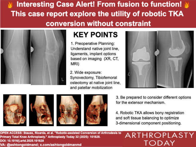 Arthroplasty Today (@arthrotoday) on Twitter photo From fusion to function!
Would you use a robot to de-fuse this situation? <a href="/stauss_r/">Ricarda Stauss</a> <a href="/pjamiesonkay/">Jamie Kay, MD</a> <a href="/TotalHipKnee/">David A. Molho, M.D.</a> <a href="/CenterRotation/">Brock Howell MD, FAAOS</a>
Visual Abstract: <a href="/ashtongoldmanmd/">Ashton Goldman, MD, FAAOS</a>
arthroplastytoday.org/article/S2352-… From fusion to function!
Would you use a robot to de-fuse this situation? <a href="/stauss_r/">Ricarda Stauss</a> <a href="/pjamiesonkay/">Jamie Kay, MD</a> <a href="/TotalHipKnee/">David A. Molho, M.D.</a> <a href="/CenterRotation/">Brock Howell MD, FAAOS</a>
Visual Abstract: <a href="/ashtongoldmanmd/">Ashton Goldman, MD, FAAOS</a>
arthroplastytoday.org/article/S2352-…