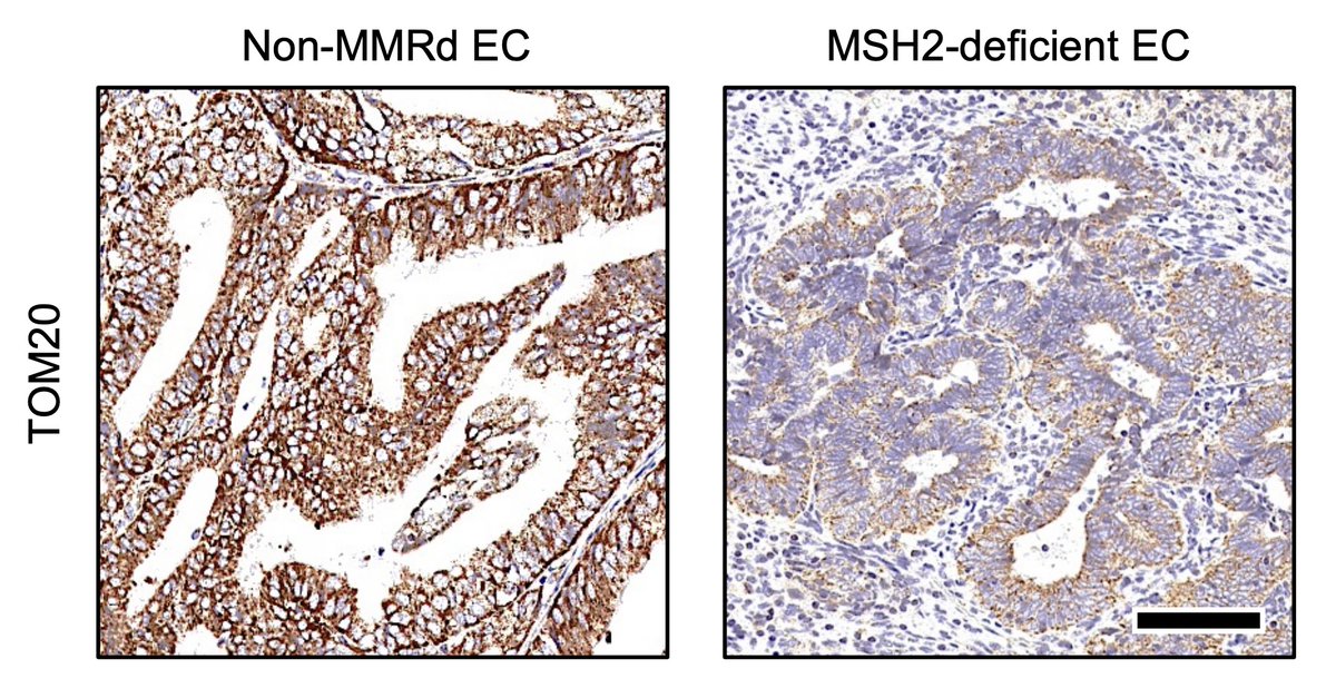 JCI insight (@jci_insight) on Twitter photo Lynch syndrome carries up to 60% lifetime risk of developing endometrial cancer & a study by <a href="/MikaylaMDPhD/">Mikayla Borthwick Bowen</a> <a href="/MelindaYatesPhD/">Melinda Yates, PhD</a> is first to identify that mitochondrial dysfunction via MSH2 loss is a mechanism for LS-EC – results bring important implications for cancer Lynch syndrome carries up to 60% lifetime risk of developing endometrial cancer & a study by <a href="/MikaylaMDPhD/">Mikayla Borthwick Bowen</a> <a href="/MelindaYatesPhD/">Melinda Yates, PhD</a> is first to identify that mitochondrial dysfunction via MSH2 loss is a mechanism for LS-EC – results bring important implications for cancer