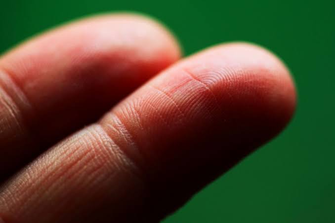 _Factopia's tweet image. Adermatoglyphia is an extremely rare genetic disorder that causes a person to have no fingerprints.