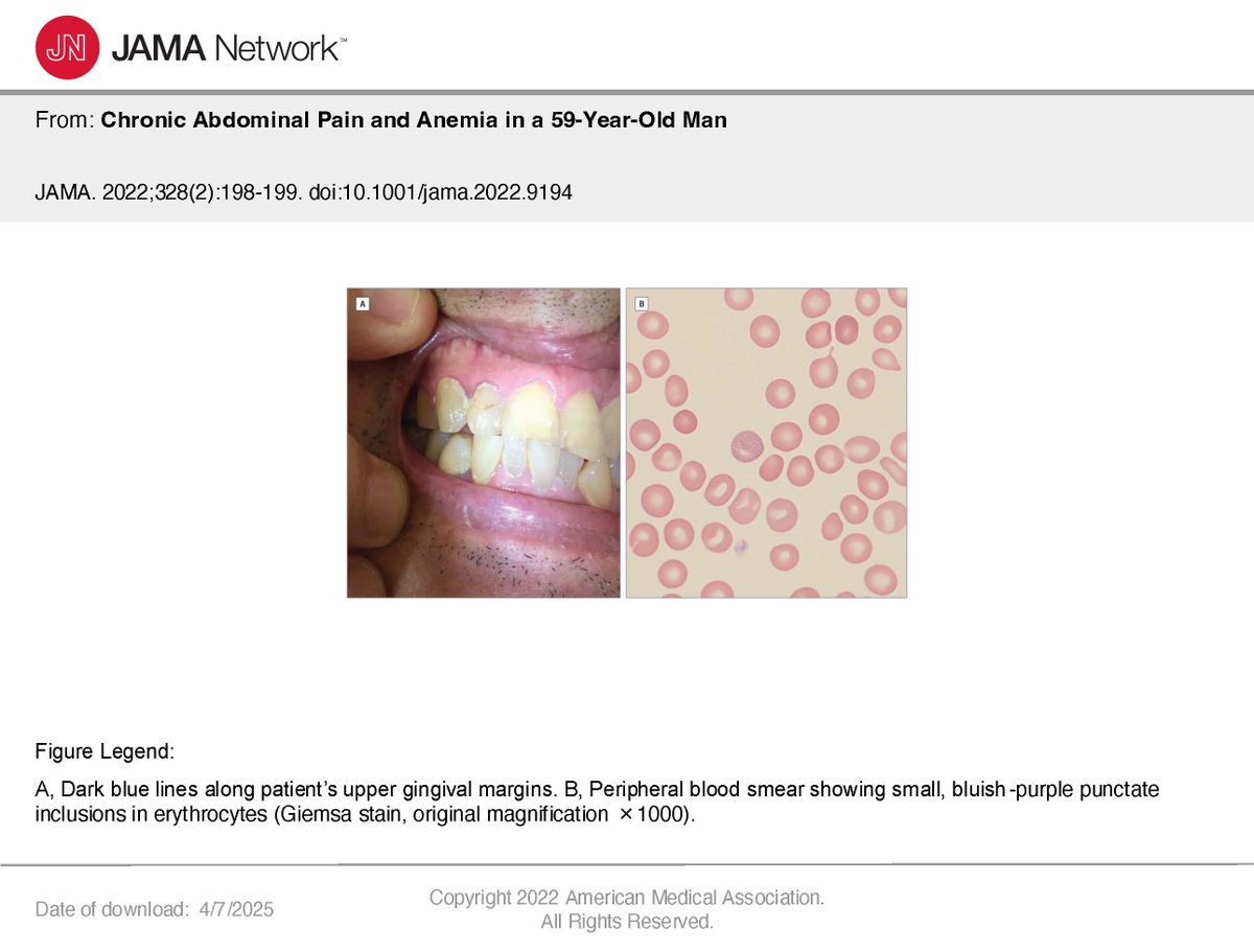Komt een man bij de dokter met chronische buikpijn, bloedarmoede en blauwe verkleuringen in zijn mond en zijn rode bloedcellen. Hij bleek loodvergiftiging te hebben. Bron: Ayurvedische voedingssupplementen, die stiekem vol met lood zaten.