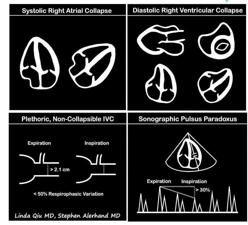 🔴Cardiac Point-Of-Care Ultrasound An Emergency Medicine #2024Review ⤵️

🔹acrobat.adobe.com/link/review?ur…
 #FOAMed #MedEd #medstudent #paramedic #Cardiology #CardioEd #medtwitter #meded #CardioTwitter #cardiotwiteros  #MedX #cardiovascular #MedTwitter #medical #medEd #cardiotwitter