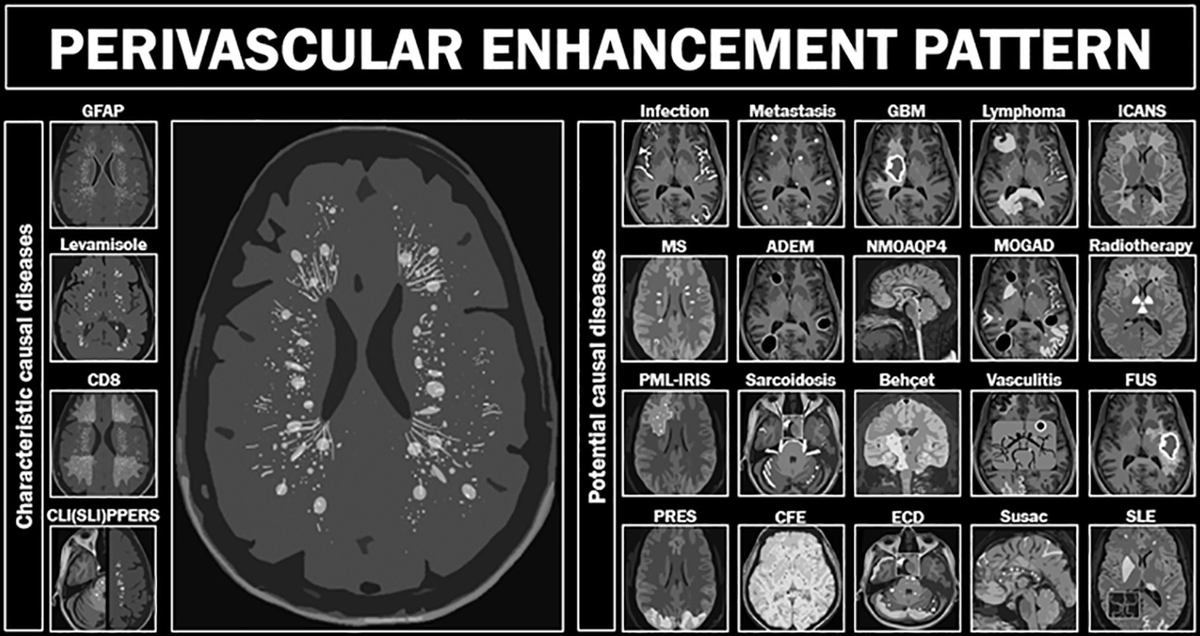 TKG_Radiology's tweet photo. 脳血管周囲増強パターンの鑑別

#Rdiag 

https://t.co/QKzlDfu6TG https://t.co/5A2E8nW9ix