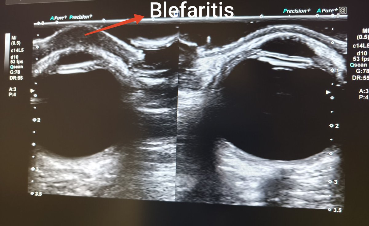 Jose Maria Palacin (@jpalacinp) on Twitter photo Mujer 82a con edema importante y dolor palpebral derecho. La #ecografiaclinica nos permite una imagen comparativa y ver tras un párpado con blefaritis que no se puede abrir. <a href="/JMMR83/">Joaquín Martínez</a> <a href="/NephroP/">NephroPOCUS</a> <a href="/ABCDEcografia/">ABCDEcografía</a> <a href="/dmiguelmolina/">Dr. Miguel Molina - Ecografia Clínica - POCUS</a> <a href="/PierpaDiNick/">Pierpaolo Di Nicolò</a> <a href="/jorgezzb/">Jorge Zegarra</a> <a href="/ecoapcat/">ecoap</a> <a href="/EcosemfyC/">EcosemFYC</a> <a href="/grecocap/">GRECOCAP</a> Mujer 82a con edema importante y dolor palpebral derecho. La #ecografiaclinica nos permite una imagen comparativa y ver tras un párpado con blefaritis que no se puede abrir. <a href="/JMMR83/">Joaquín Martínez</a> <a href="/NephroP/">NephroPOCUS</a> <a href="/ABCDEcografia/">ABCDEcografía</a> <a href="/dmiguelmolina/">Dr. Miguel Molina - Ecografia Clínica - POCUS</a> <a href="/PierpaDiNick/">Pierpaolo Di Nicolò</a> <a href="/jorgezzb/">Jorge Zegarra</a> <a href="/ecoapcat/">ecoap</a> <a href="/EcosemfyC/">EcosemFYC</a> <a href="/grecocap/">GRECOCAP</a>