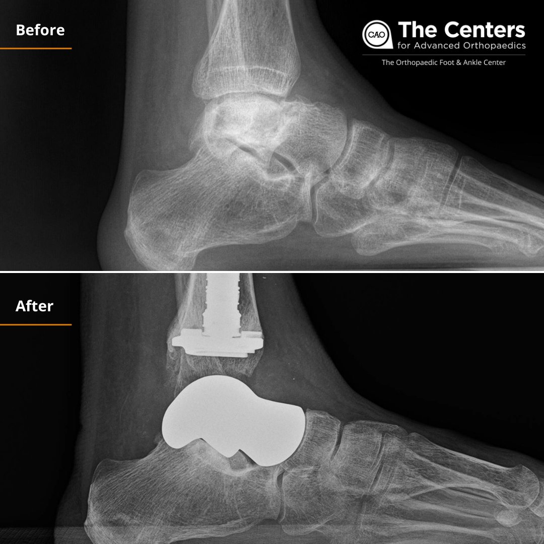 Footankledc's tweet image. A great before and after from a very happy patient! 👏
Total ankle + total talus replacement = major pain relief ✨

Learn more by visiting footankledc.com 🦶

----

#totalanklereplacement #talusreplacement