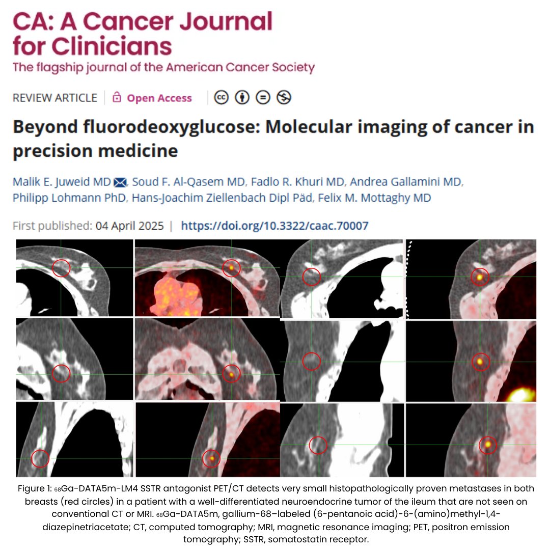 CA: A Cancer Journal for Clinicians (@cacancerjournal) on Twitter photo New in CA: This #OpenAccess review examines molecular imaging probes beyond fluorodeoxyglucose PET, including clinical and investigational tracers targeting tumor biology across cancer types: acsjournals.onlinelibrary.wiley.com/doi/full/10.33…
<a href="/OncoAlert/">OncoAlert</a> <a href="/DrFadloKhuri/">Dr. Fadlo Khuri</a> <a href="/ph_lohmann/">Philipp Lohmann</a> #PrecisionMedicine New in CA: This #OpenAccess review examines molecular imaging probes beyond fluorodeoxyglucose PET, including clinical and investigational tracers targeting tumor biology across cancer types: acsjournals.onlinelibrary.wiley.com/doi/full/10.33…
<a href="/OncoAlert/">OncoAlert</a> <a href="/DrFadloKhuri/">Dr. Fadlo Khuri</a> <a href="/ph_lohmann/">Philipp Lohmann</a> #PrecisionMedicine