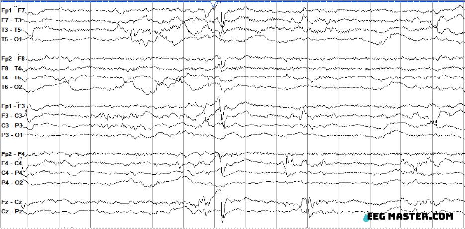 2-day-old newborn born at 38 weeks gestation undergoing therapeutic hypothermia for hypoxic-ischemic encephalopathy. What is the name of the finding (white arrowhead)? Click on this link to view the options, submit your answer and see the explanation. eegmaster.com/eegmaster/quiz…
