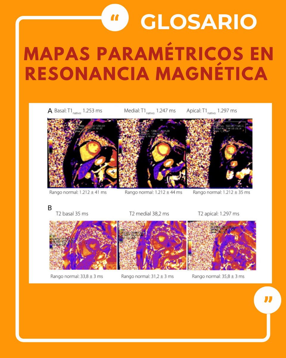 🧠 Mapas Paramétricos en RM

📍T1 Mapping: ↑ en fibrosis, edema, inflamación. ↓ en grasa o hierro.
📍T2 Mapping: ↑ en edema agudo (miocarditis, infarto).
📍T2* Mapping: ↓ en sobrecarga de hierro.
📍VEC: Detecta fibrosis difusa, más sensible que el LGE.