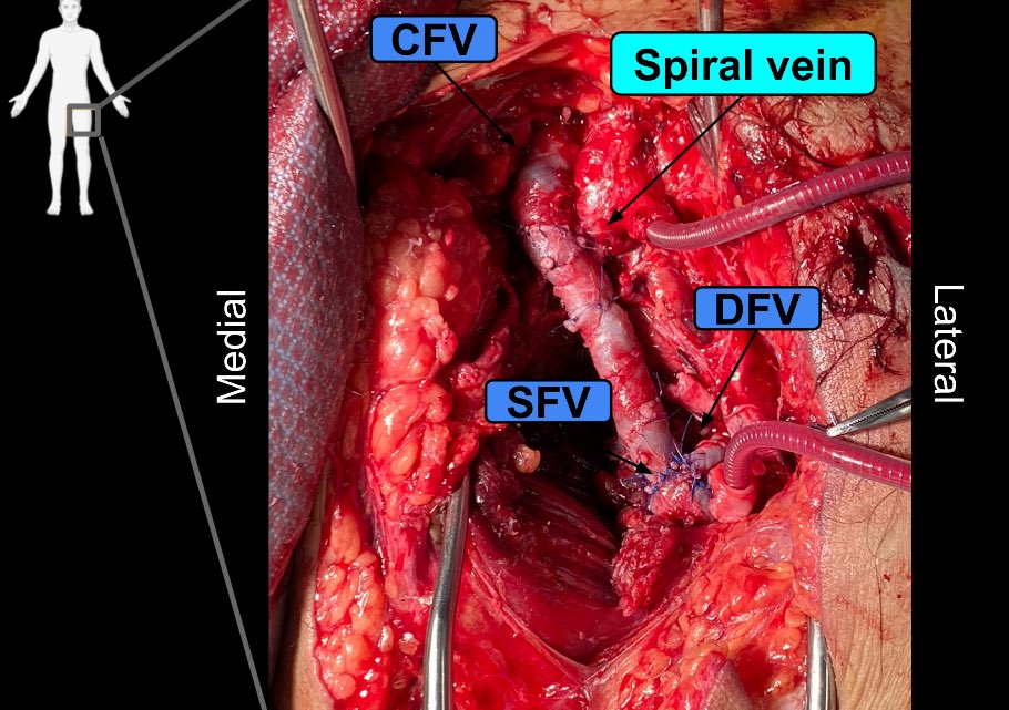 Nicola Habash (@nicolahabash7) on Twitter photo SCVS25 is in the books! Thank you to my mentors <a href="/mnooromid/">Michael Nooromid</a> and <a href="/DrBabakAbai/">Babak Abai</a> for the opportunity to present this case!
GSW -> Temporary intravascular shunts -> Spiral graft with ipsilateral GSV fashioned on a 32 Fr CT -> Size matched conduit for venous outflow ā> Leg saved SCVS25 is in the books! Thank you to my mentors <a href="/mnooromid/">Michael Nooromid</a> and <a href="/DrBabakAbai/">Babak Abai</a> for the opportunity to present this case!
GSW -> Temporary intravascular shunts -> Spiral graft with ipsilateral GSV fashioned on a 32 Fr CT -> Size matched conduit for venous outflow ā> Leg saved