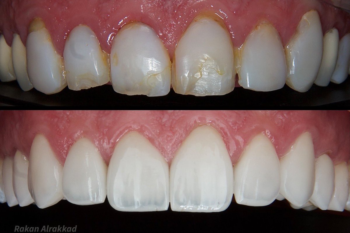 New smile transformation 🤝🏻🤍

ابتسامة جديدة بتفاصيل طبيعية ..