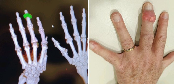 Tophus in the distal interphalangeal joint of the third finger.

Why (just) there? 

#tophus 
#gout #goutyarthritis 
#dect 
<a href="/reuma_santpau/">Reumatologia Sant Pau-Dos de Maig</a> <a href="/geacser/">GEACSER</a>