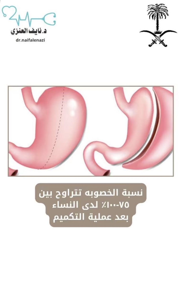 من أبرز الفوائد الصحية بعد عملية التكميم تحسّن الخصوبة لدى النساء بشكل ملحوظ 
لذلك التكميم ليس فقط لتحسين الشكل بل لتحسين جودة الحياة كاملة 

#د_نايف_العنزي #رابطة_المتكممين #الرياض 
#مملكة_المتكممين #قص_المعده #تكميم #إسأل_المتكممين #فضفضة_المتكممين #السعوديه