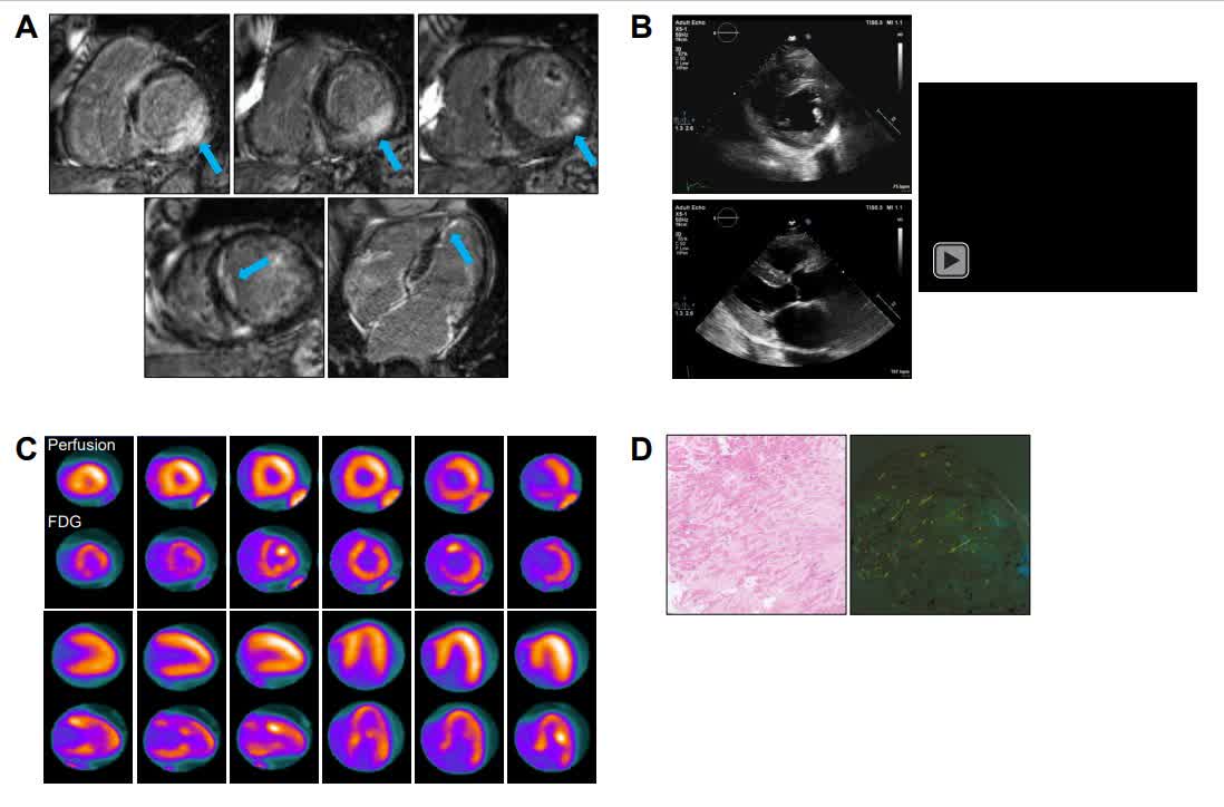 Circ: Heart Failure (@circhf) on Twitter photo We present the case of a patient with inflammation on cardiac PET and focal LGE on cardiac MRI ultimately diagnosed with cardiac amyloidosis <a href="/DrRKarra/">Ravi Karra</a> <a href="/MGKhouri_md/">Michel Khouri</a> <a href="/kpflores28/">Karen Flores</a> #AHAJournals ahajrnls.org/3YknUu2 We present the case of a patient with inflammation on cardiac PET and focal LGE on cardiac MRI ultimately diagnosed with cardiac amyloidosis <a href="/DrRKarra/">Ravi Karra</a> <a href="/MGKhouri_md/">Michel Khouri</a> <a href="/kpflores28/">Karen Flores</a> #AHAJournals ahajrnls.org/3YknUu2