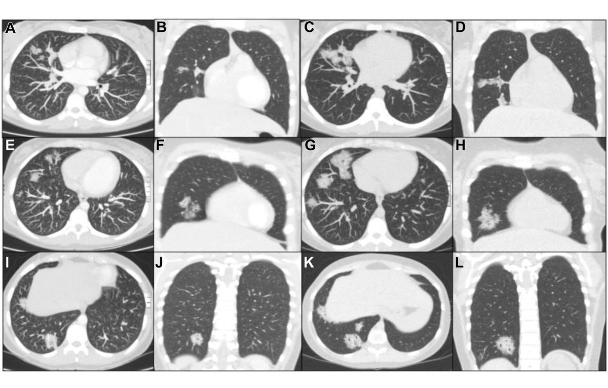 I thought this was a striking case report: 24 year old with lung cancer likely caused by CBD vaping

sciencedirect.com/science/articl…