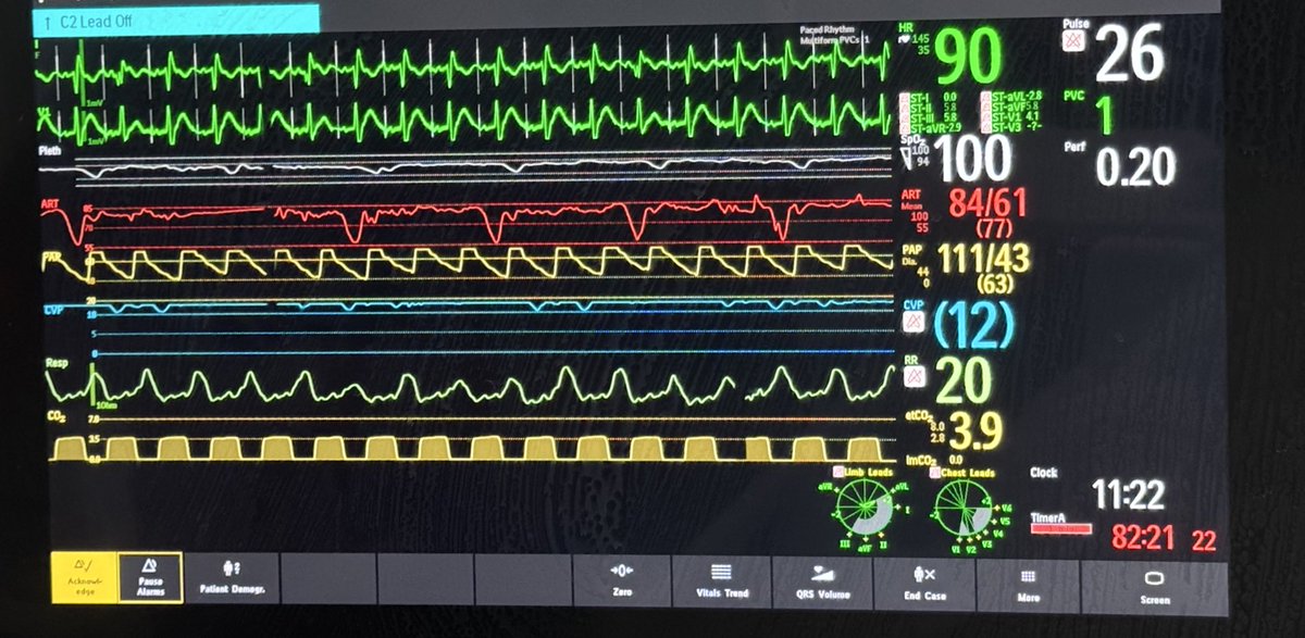 Hatem Soliman, FRCP, FEACVI, FASE, FHEA (@echosoliman) on Twitter photo Please share your thoughts on this one..
#ThePeopleVentricle
<a href="/msiuba/">Matt Siuba</a> <a href="/khaycock2/">korbinhaycockmd</a> <a href="/JasonKatzMD/">Jason N. Katz</a> <a href="/JHMontfort10/">Jaime Hernandez-Montfort</a> <a href="/nicoa002/">Alina Nicoara</a>
#MedEd Please share your thoughts on this one..
#ThePeopleVentricle
<a href="/msiuba/">Matt Siuba</a> <a href="/khaycock2/">korbinhaycockmd</a> <a href="/JasonKatzMD/">Jason N. Katz</a> <a href="/JHMontfort10/">Jaime Hernandez-Montfort</a> <a href="/nicoa002/">Alina Nicoara</a>
#MedEd