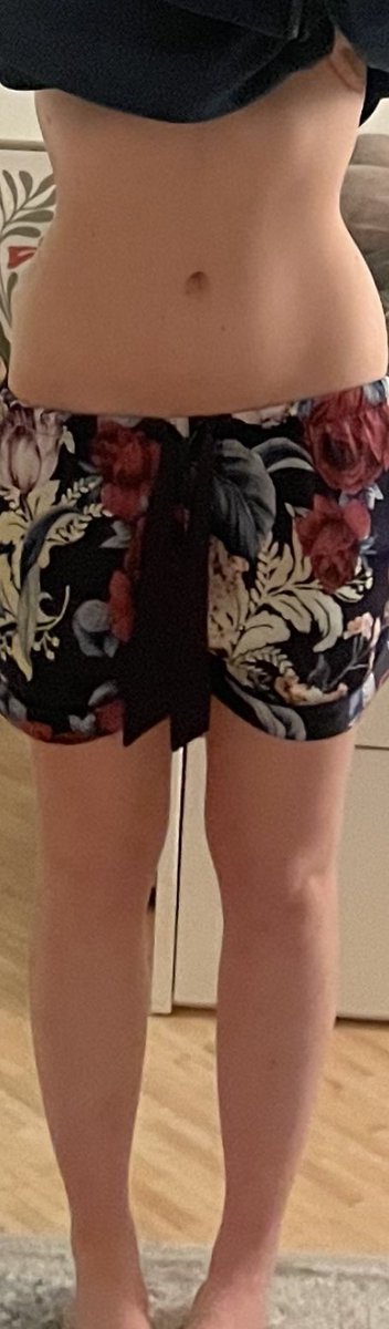 ganglioned's tweet photo. Am I fucking delulu or is there really a bit of a difference 😭😭😭😭😭 helppppp
End of February vs now https://t.co/m5RGBXMygp