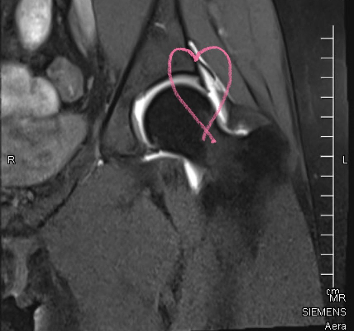 haleylboylan's tweet photo. I’ve been in a constant state of crashing out over learning I need surgery on my other hip for the past week straight… I literally have beef with my own body because how did I get lucky enough to have both hypermobility &amp; extra bone formation in my hips🥲 https://t.co/5VcaXWUGmx