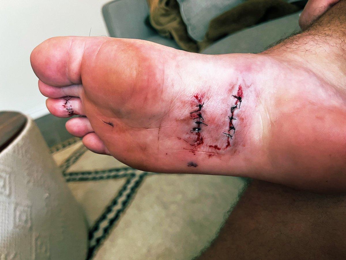 JosiahHayward's tweet photo. I know firsthand, I recommend not stepping on glass https://t.co/UPP4TLMsF4