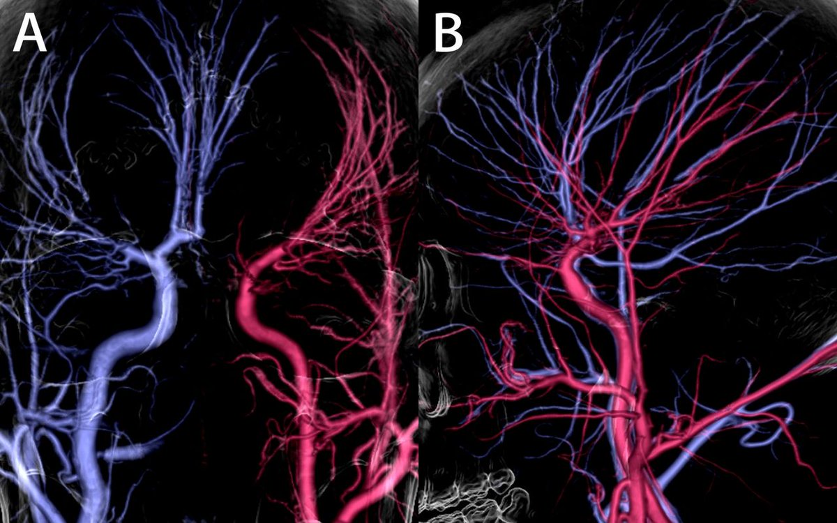 Cerebrovascular cinematic rendering of multisystemic smooth muscle dysfunction syndrome
svn.bmj.com/content/early/…