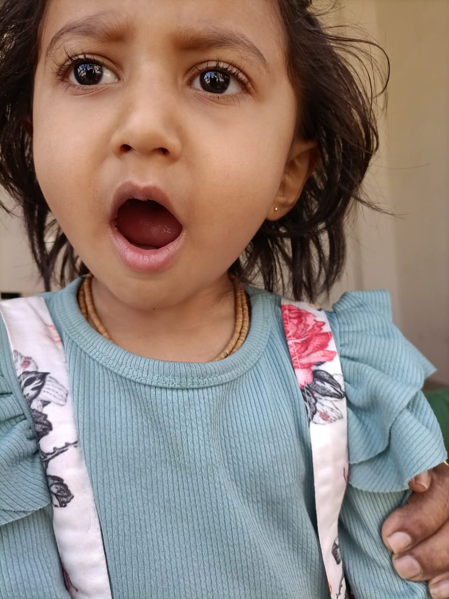 CollectorRjt's tweet image. RBSK પ્રોગ્રામ અંતર્ગત રાજકોટ જિલ્લાના ગોંડલ તાલુકાના ક્રીવા સોજિત્રાના જન્મજાત ક્લેફ્ટ પેલેટ ની ખામી દૂર કરવામાં આવેલ બાળક થયુ સ્વસ્થ.