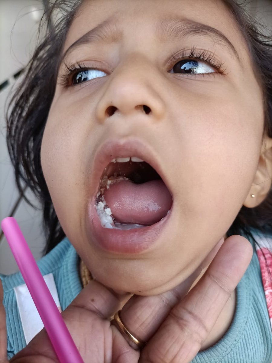 CollectorRjt's tweet image. RBSK પ્રોગ્રામ અંતર્ગત રાજકોટ જિલ્લાના ગોંડલ તાલુકાના ક્રીવા સોજિત્રાના જન્મજાત ક્લેફ્ટ પેલેટ ની ખામી દૂર કરવામાં આવેલ બાળક થયુ સ્વસ્થ.