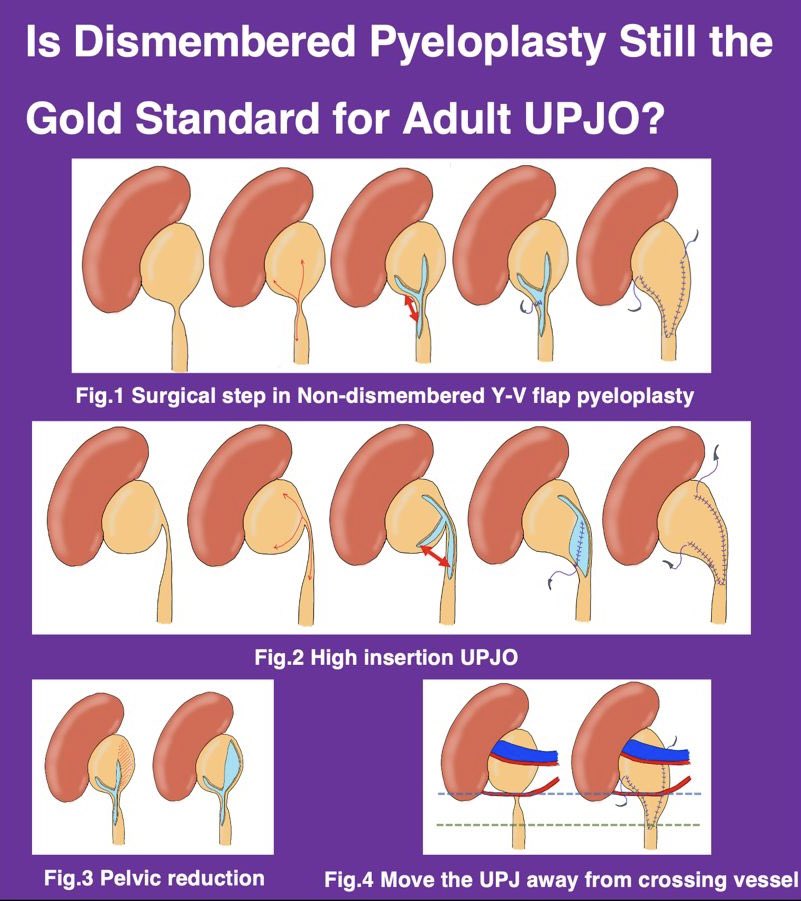Lee Zhao (@lee_c_zhao) on Twitter photo asked by folks #imoru25, #eau25
Non-transecting concept for UPJO. One operation to treat them all: high insertion, adynamic segment, crossing vessel. preserves vascularity. Urethroplasty is now non-transecting, why not ureter? <a href="/IMORU/">IMORU IX</a> @uroweb. illustration by <a href="/ratt_watt/">Wattanachai Ratanapornsompong</a> asked by folks #imoru25, #eau25
Non-transecting concept for UPJO. One operation to treat them all: high insertion, adynamic segment, crossing vessel. preserves vascularity. Urethroplasty is now non-transecting, why not ureter? <a href="/IMORU/">IMORU IX</a> @uroweb. illustration by <a href="/ratt_watt/">Wattanachai Ratanapornsompong</a>