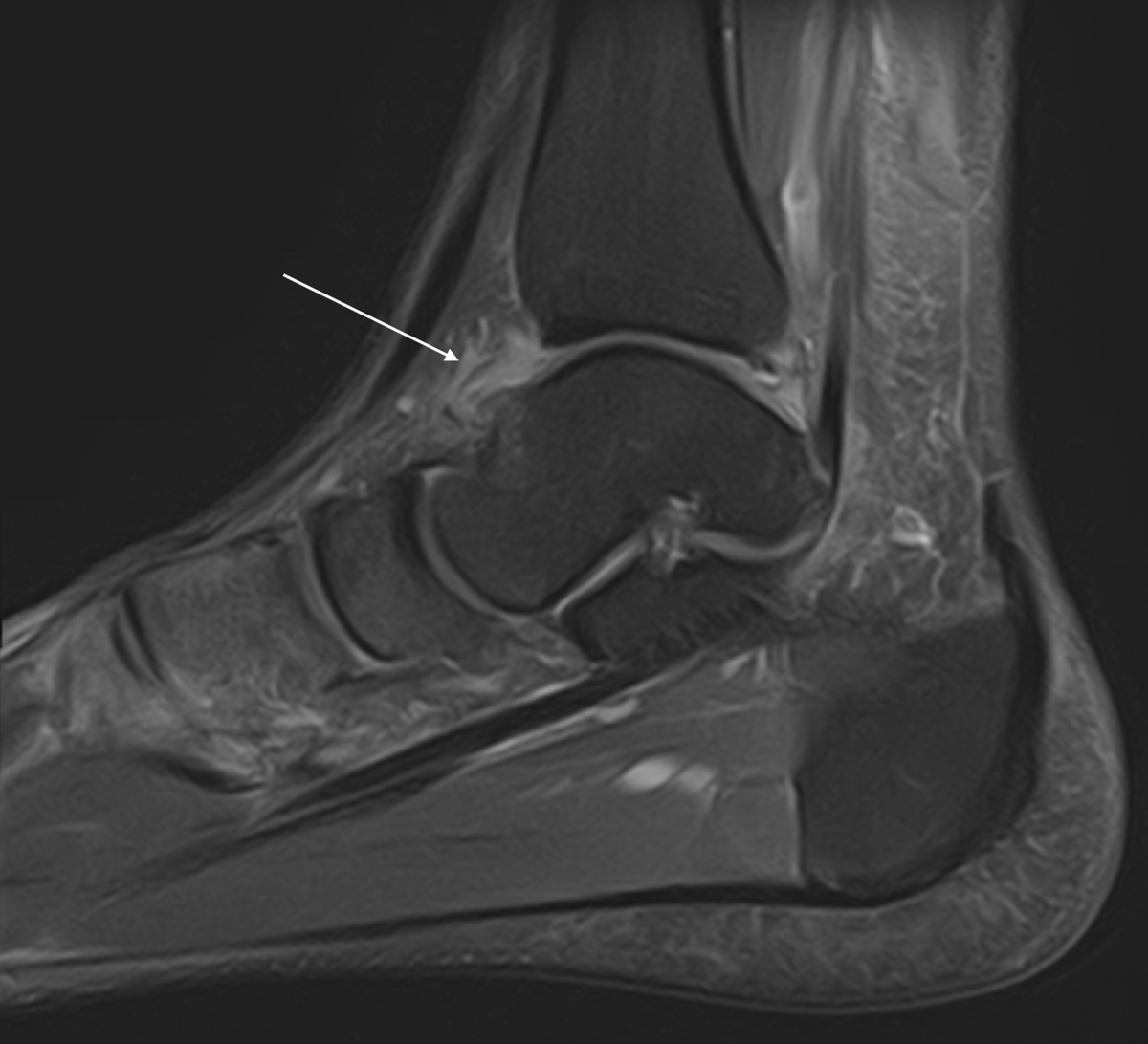 DrJN_SportsMed's tweet photo. THREAD ALERT 🚨🚨

Seen loads of interesting & 'left-field' foot & ankle cases over the last week so I thought I'd post them 🦶👣

1. Footballer 

Anterior ankle pain on powerful kick, sprint & inclines

When very irritable, gets an uncomfortable 'flicking' sensation

Pain reproduced on dynamic lunge & resisted dorsiflexion 

Tender over tibialis anterior & into anterior joint recess

MRI shows inflammation anterior ankle joint line

POCUS video - large dorsal talar ostophyte irritating TA tendon on active DF / PF

So, 2 problems - 'footballers ankle' plus compression of TA tendon under load & through ROM

US guided injection to anterior ankle impingement zone, podiatry & physio input before RTP