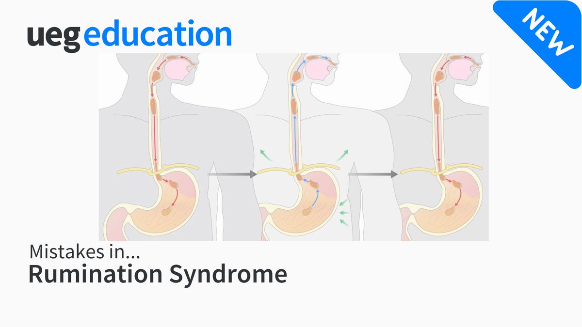 Despite a well-defined mechanism, rumination syndrome remains underdiagnosed and undertreated. This article reviews its dual classification (DGBI &amp; eating disorder), outlines its pathophysiology, and highlights key challenges in diagnosis &amp; management.

🔗 ueg.eu/mistakes-in-gu…