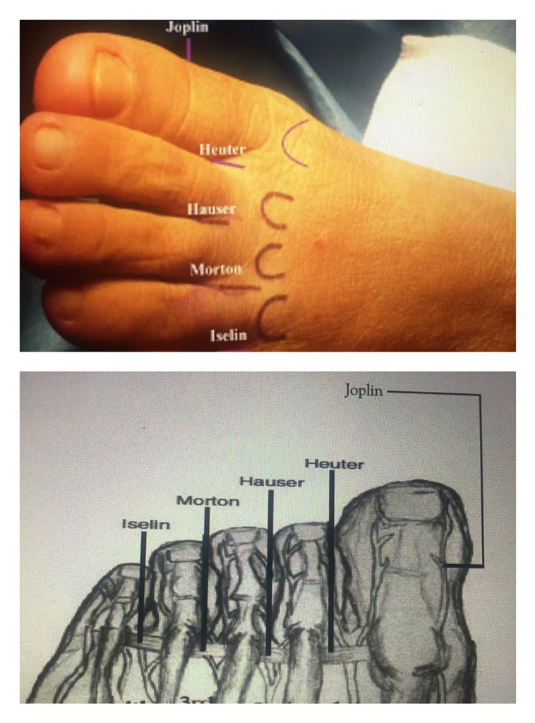 ClinicaCEMTRO (@clinicacemtro) on Twitter photo 🔴 ¿Conoces los tipos de neuromas del pie? 🦶🔴
El <a href="/DrSergiohorte/">Dr. Sergio Hortelano</a> nos explica los diferentes tipos de neuropatías plantares:
✅ Joplin: Nervio digital plantar medial Hallux
✅ Heuter: 1º espacio
✅ Hauser: 2º espacio
✅ Morton: 3º espacio (el más frecuente, 75%)
✅ Iselin: 4º 🔴 ¿Conoces los tipos de neuromas del pie? 🦶🔴
El <a href="/DrSergiohorte/">Dr. Sergio Hortelano</a> nos explica los diferentes tipos de neuropatías plantares:
✅ Joplin: Nervio digital plantar medial Hallux
✅ Heuter: 1º espacio
✅ Hauser: 2º espacio
✅ Morton: 3º espacio (el más frecuente, 75%)
✅ Iselin: 4º