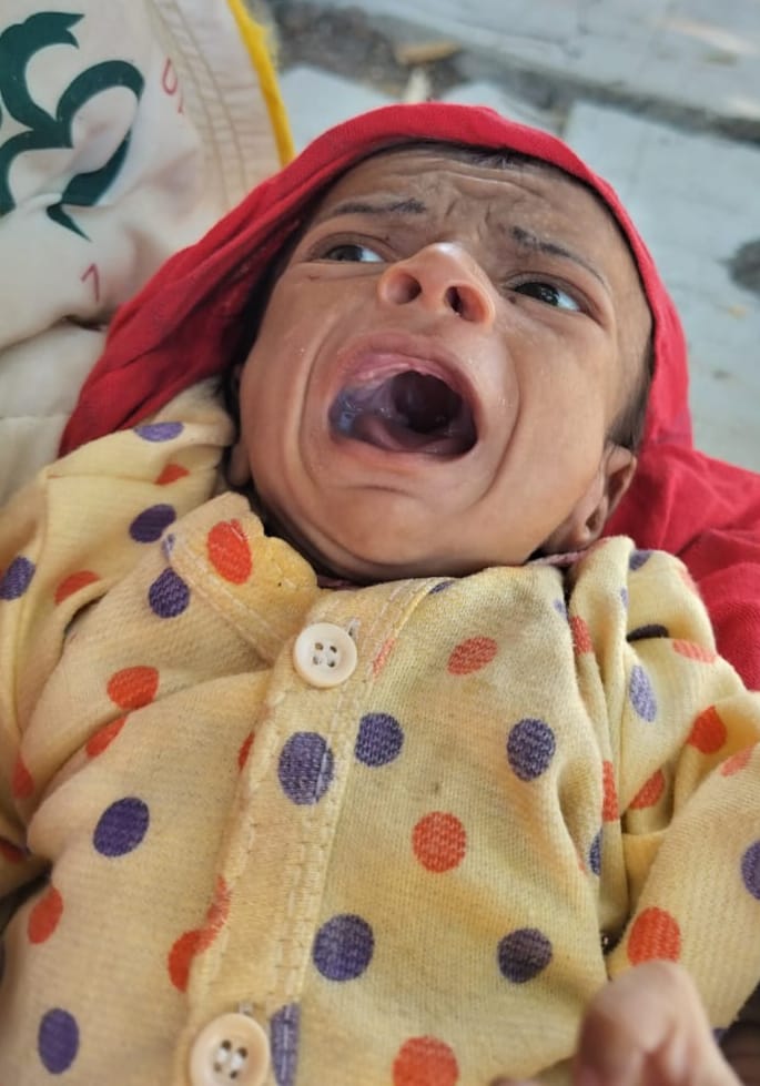 CollectorRjt's tweet image. જામકંડોરણા તાલુકાના હરિયાસણ ગામમાં ખેત મજૂરી કરતા પરિવારના હરમલ વસુનીયાને RBSK પ્રોગ્રામ અંતર્ગત NICU રાજકોટ અને NRC રાજકોટ માં સઘન સારવાર કરી SAM(Severe Acute Malnutrition)માંથી બહાર લાવી બાળક થયુ સ્વસ્થ.